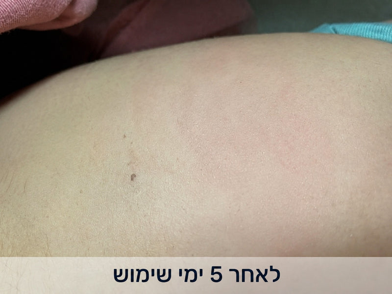 לאחר 5 ימי שימוש